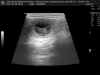 ultrasound_ischyma_l2_litter.jpg (64341 Byte)